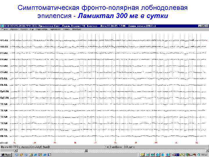 Симптоматическая фронто-полярная лобнодолевая эпилепсия - Ламиктал 300 мг в сутки 