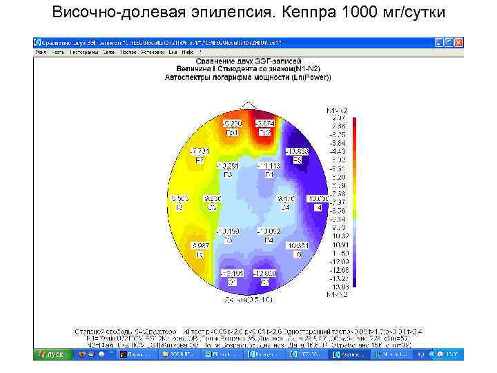 Височно-долевая эпилепсия. Кеппра 1000 мг/сутки 