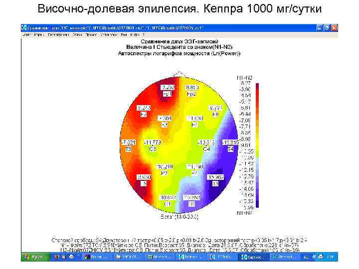 Височно-долевая эпилепсия. Кеппра 1000 мг/сутки 