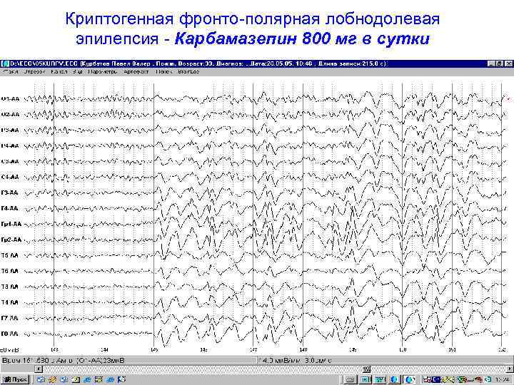 Криптогенная фронто-полярная лобнодолевая эпилепсия - Карбамазепин 800 мг в сутки 