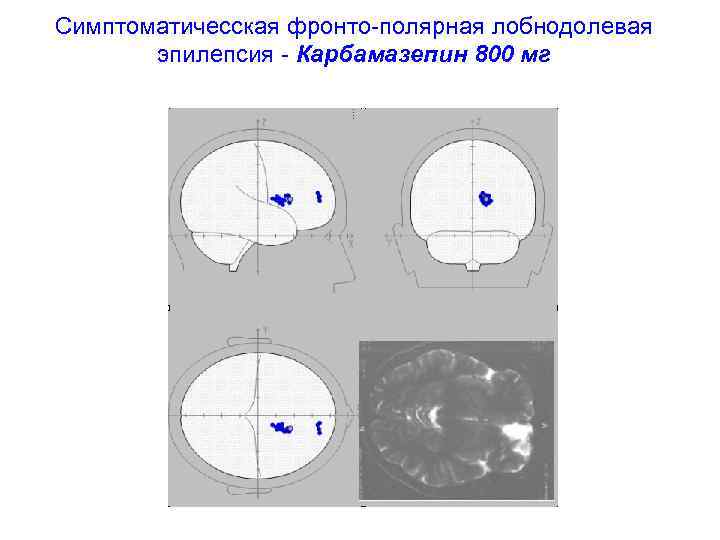 Симптоматичесская фронто-полярная лобнодолевая  эпилепсия - Карбамазепин 800 мг 