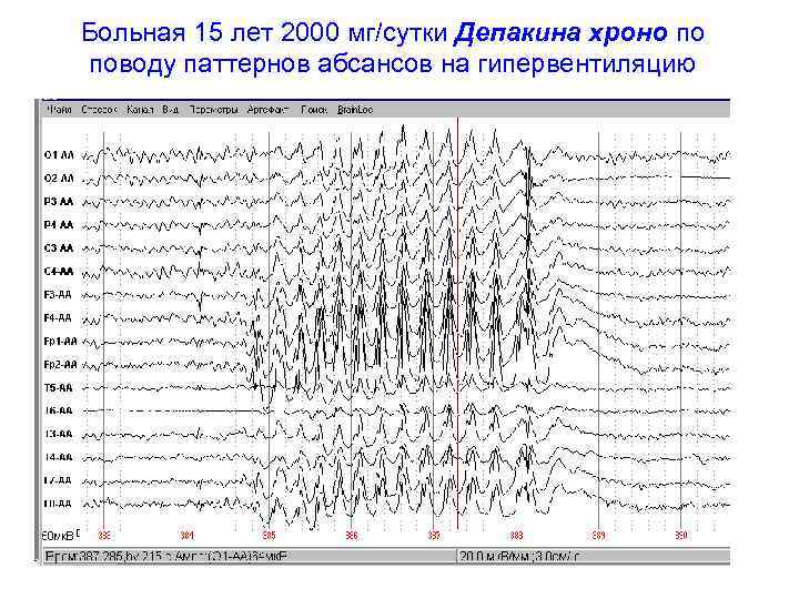 Схема отмены депакина