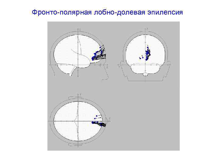 Фронто-полярная лобно-долевая эпилепсия 
