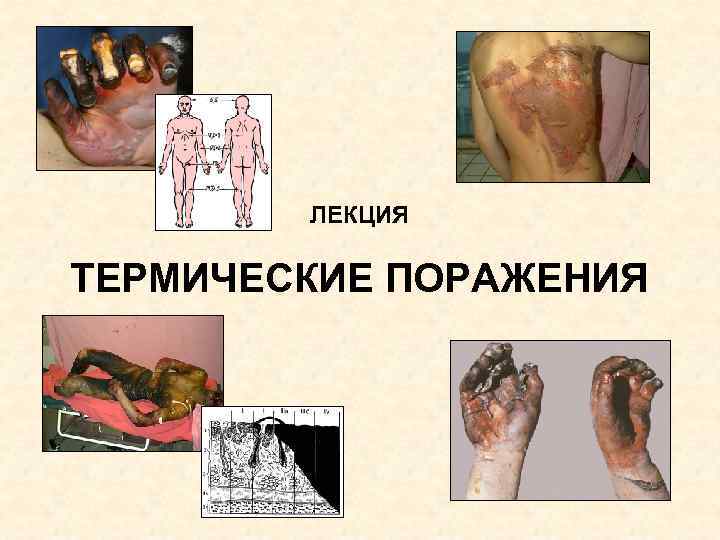 ЛЕКЦИЯ ТЕРМИЧЕСКИЕ ПОРАЖЕНИЯ ЛЕКЦИЯ ТЕРМИЧЕСКИЕ ПОРАЖЕНИЯ