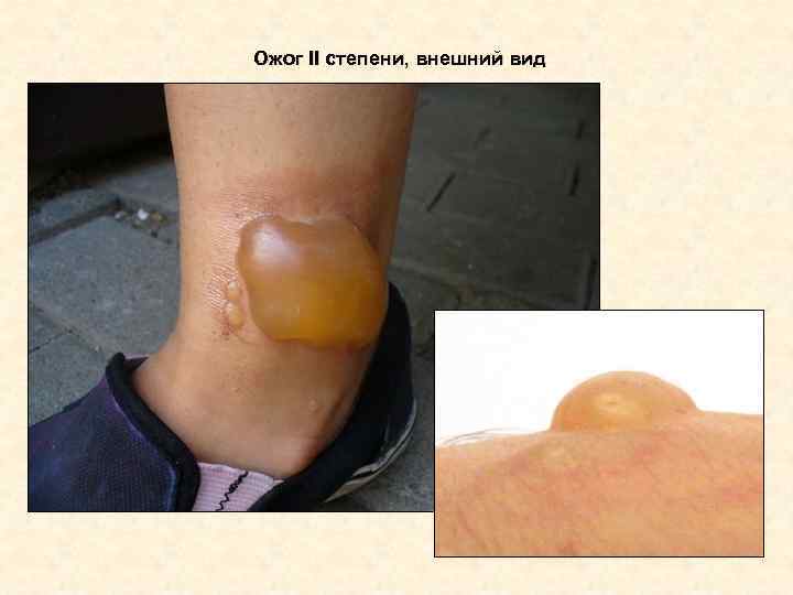 Ожог II степени, внешний вид Ожог II степени, внешний вид
