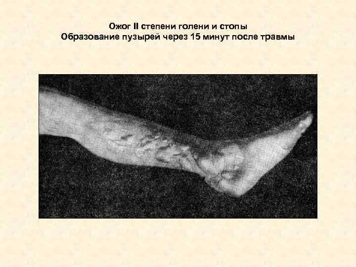 Ожог II степени голени и стопы Образование пузырей через 15 минут Ожог II степени голени и стопы Образование пузырей через 15 минут