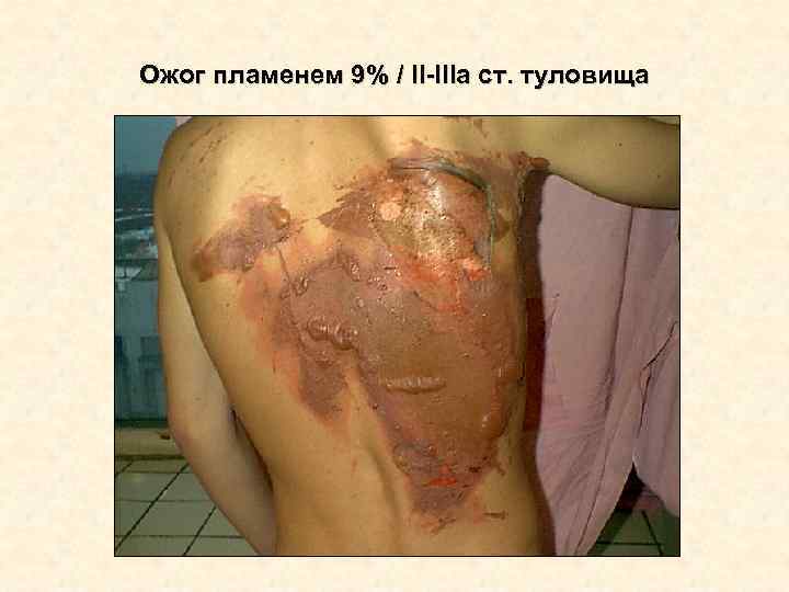 Ожог пламенем 9% / II-IIIа ст. туловища Ожог пламенем 9% / II-IIIа ст. туловища