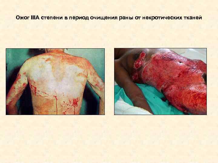 Ожог IIIА степени в период очищения раны от некротических тканей Ожог IIIА степени в период очищения раны от некротических тканей