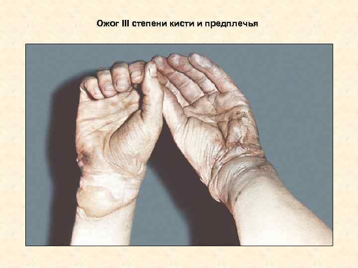 Ожог III степени кисти и предплечья Ожог III степени кисти и предплечья
