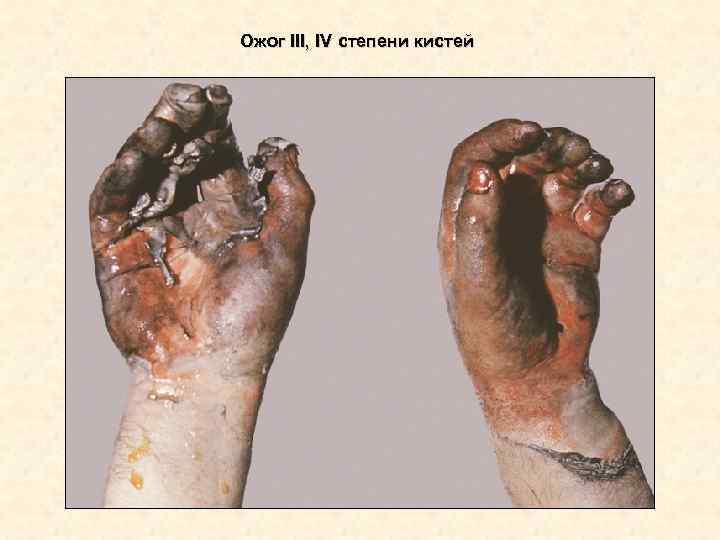 Ожог III, IV степени кистей Ожог III, IV степени кистей
