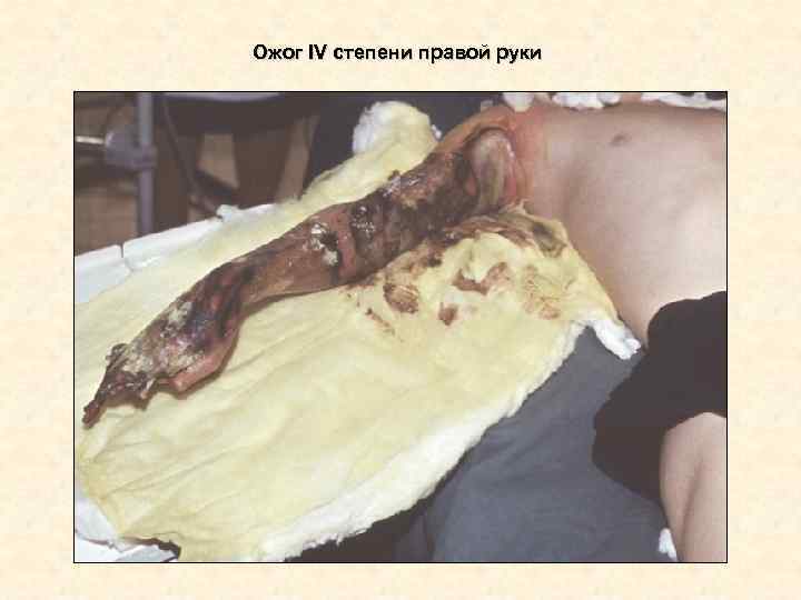Ожог IV степени правой руки Ожог IV степени правой руки