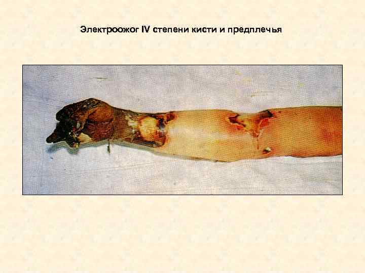 Электроожог IV степени кисти и предплечья Электроожог IV степени кисти и предплечья