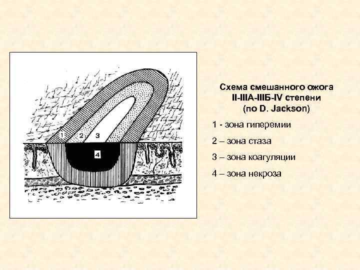 Схема смешанного ожога II-IIIА-IIIБ-IV степени (по D. Jackson) 1 - зона Схема смешанного ожога II-IIIА-IIIБ-IV степени (по D. Jackson) 1 - зона
