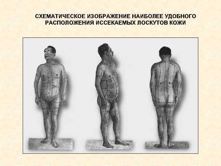 СХЕМАТИЧЕСКОЕ ИЗОБРАЖЕНИЕ НАИБОЛЕЕ УДОБНОГО РАСПОЛОЖЕНИЯ ИССЕКАЕМЫХ ЛОСКУТОВ КОЖИ СХЕМАТИЧЕСКОЕ ИЗОБРАЖЕНИЕ НАИБОЛЕЕ УДОБНОГО РАСПОЛОЖЕНИЯ ИССЕКАЕМЫХ ЛОСКУТОВ КОЖИ