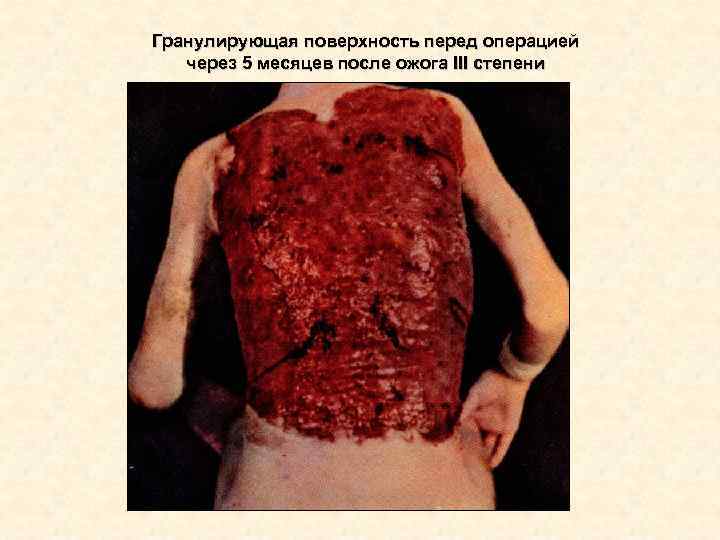 Гранулирующая поверхность перед операцией через 5 месяцев после ожога III степени Гранулирующая поверхность перед операцией через 5 месяцев после ожога III степени