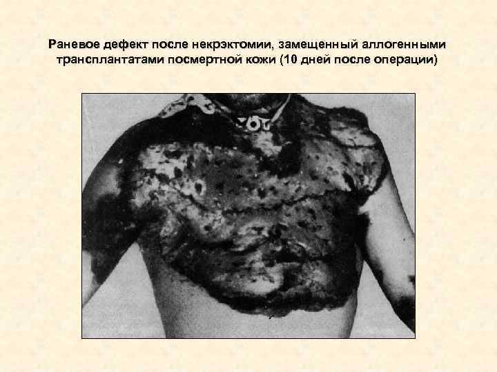 Раневое дефект после некрэктомии, замещенный аллогенными трансплантатами посмертной кожи (10 дней после операции) Раневое дефект после некрэктомии, замещенный аллогенными трансплантатами посмертной кожи (10 дней после операции)