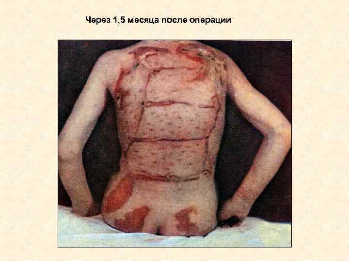 Через 1, 5 месяца после операции Через 1, 5 месяца после операции