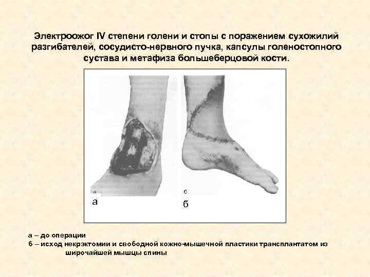 Электроожог IV степени голени и стопы с поражением сухожилий разгибателей, сосудисто-нервного пучка, капсулы голеностопного Электроожог IV степени голени и стопы с поражением сухожилий разгибателей, сосудисто-нервного пучка, капсулы голеностопного