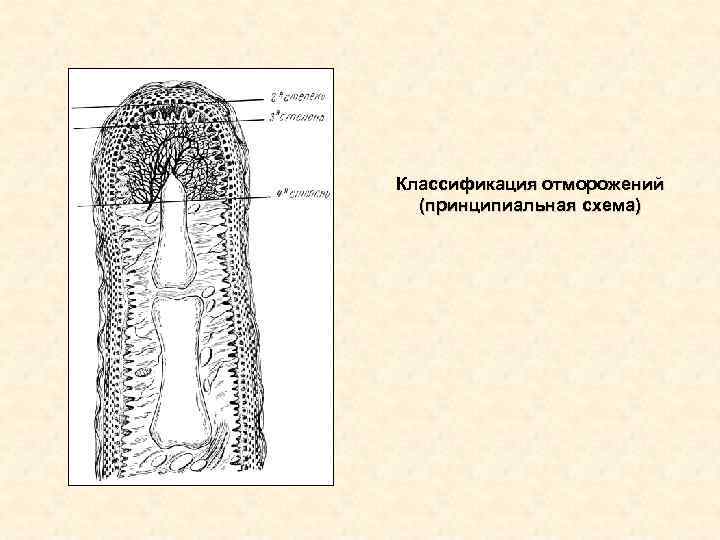 Классификация отморожений (принципиальная схема) Классификация отморожений (принципиальная схема)