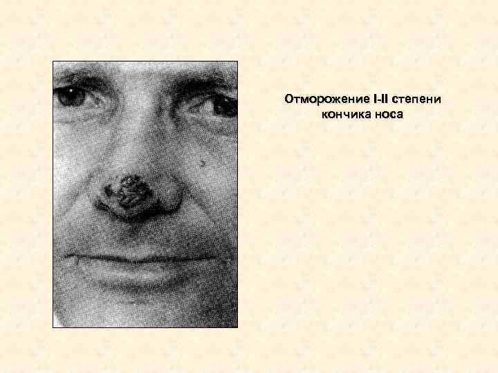 Отморожение I-II степени кончика носа Отморожение I-II степени кончика носа