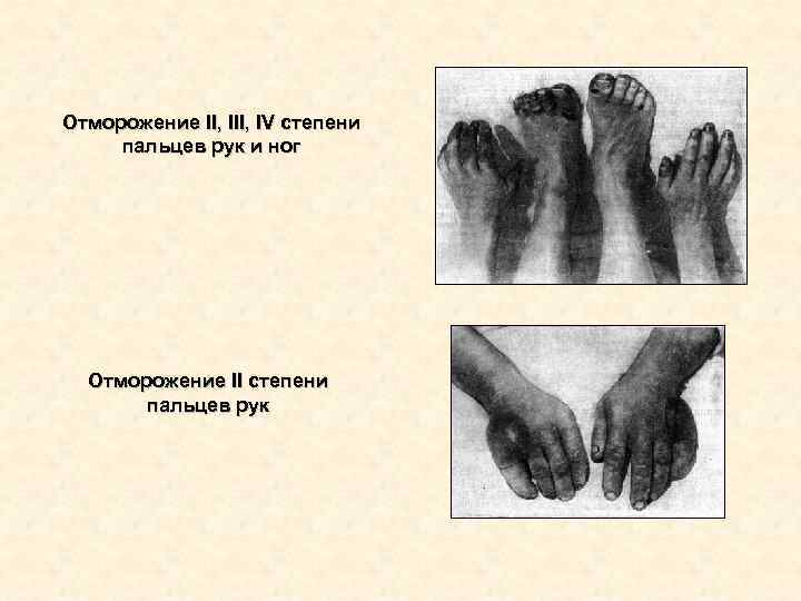 Отморожение II, IV степени пальцев рук и ног Отморожение II степени пальцев Отморожение II, IV степени пальцев рук и ног Отморожение II степени пальцев