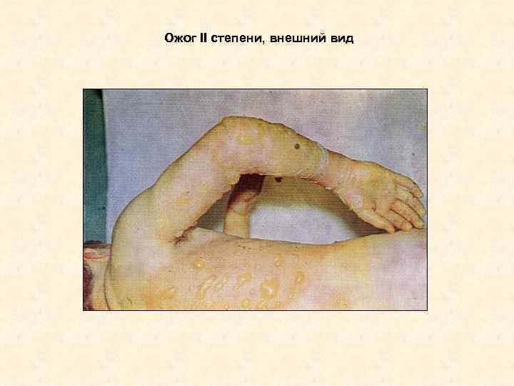 Ожог II степени, внешний вид Ожог II степени, внешний вид