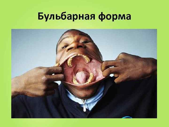 Бульбарная форма 