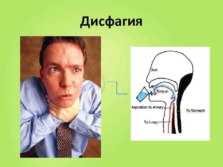 Дисфагия патофизиология презентация