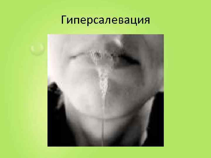 Гиперсалевация 