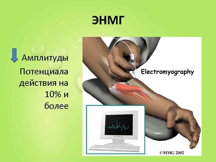     ЭНМГ  • Амплитуды  Потенциала действия на  10%