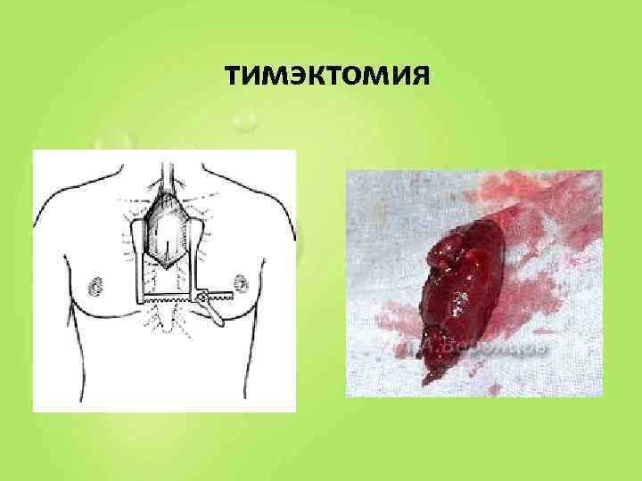 тимэктомия 