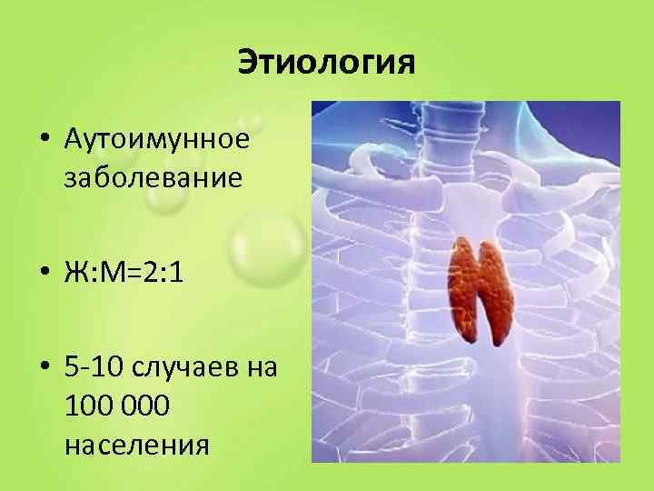    Этиология • Аутоимунное  заболевание  • Ж: М=2: 1 