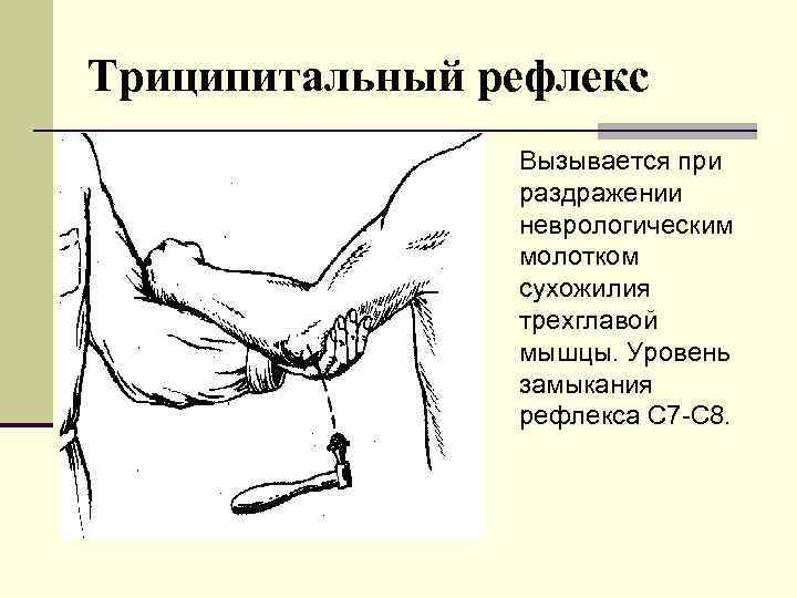 Триципитальный рефлекс Вызывается при раздражении неврологическим Триципитальный рефлекс Вызывается при раздражении неврологическим