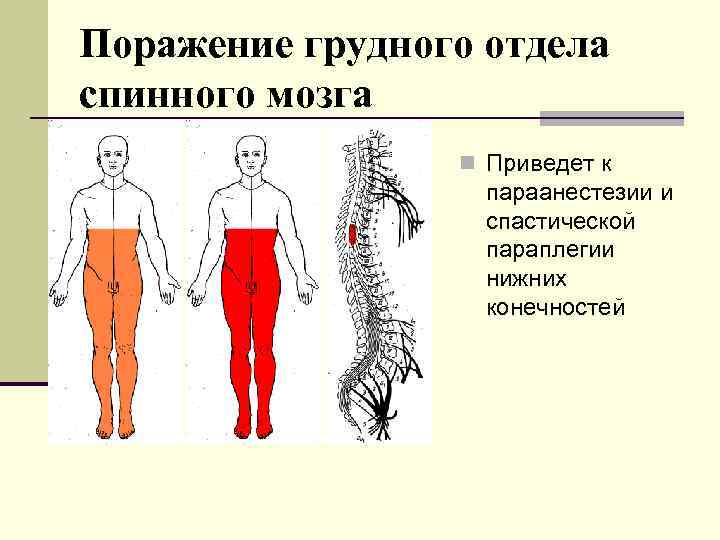 Поражение спинного. Поражение грудных сегментов спинного мозга. Поражение грудного отдела спинного мозга. Синдром поражения спинного мозга грудной уровень. Спастический паралич нижних конечностей.