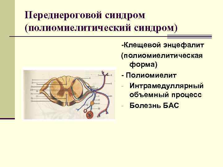 Переднероговой синдром (полиомиелитический синдром) -Клещевой энцефалит (полиомиелитическая Переднероговой синдром (полиомиелитический синдром) -Клещевой энцефалит (полиомиелитическая