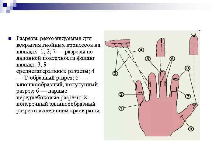 Схема разрезов при панарициях