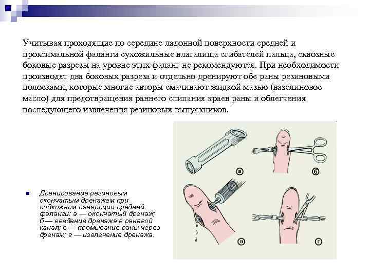 Учитывая проходящие по середине ладонной поверхности средней и проксимальной фаланги сухожильные влагалища сгибателей пальца,