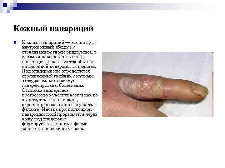 Кожный панариций n  Кожный панариций — это по сути внутрикожный абсцесс с отслаиванием