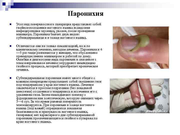      Паронихия n  Этот вид поверхностного панариция представляет