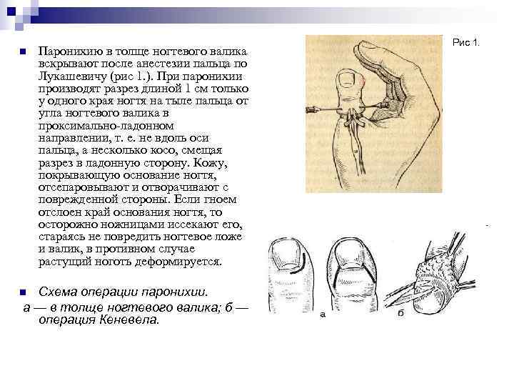     Рис 1. n  Паронихию в толще ногтевого валика вскрывают