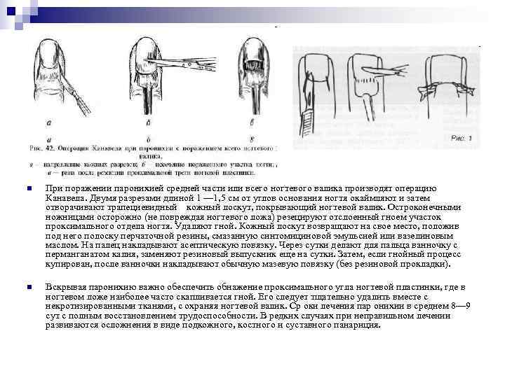 n  При поражении паронихией средней части или всего ногтевого валика производят операцию Канавела.
