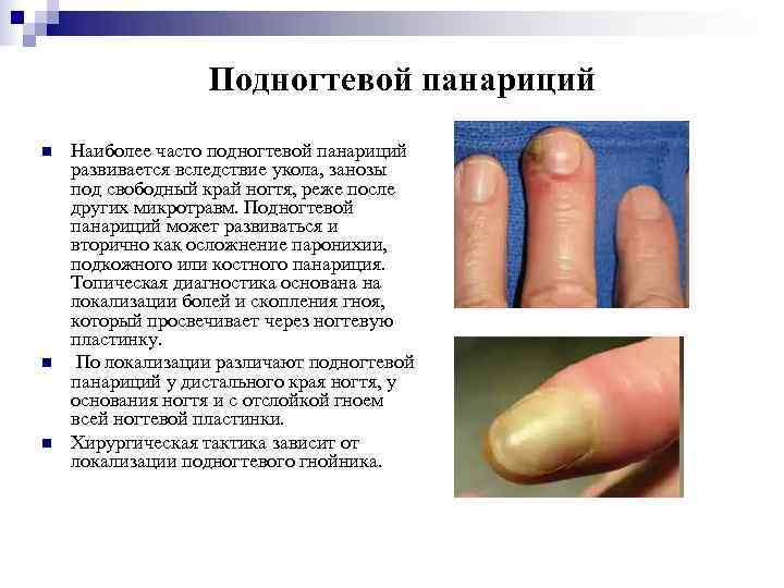    Подногтевой панариций n  Наиболее часто подногтевой панариций развивается вследствие укола,