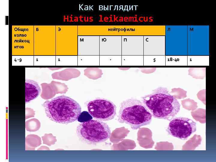     Как выглядит   Hiatus leikaemicus Общее  Б 