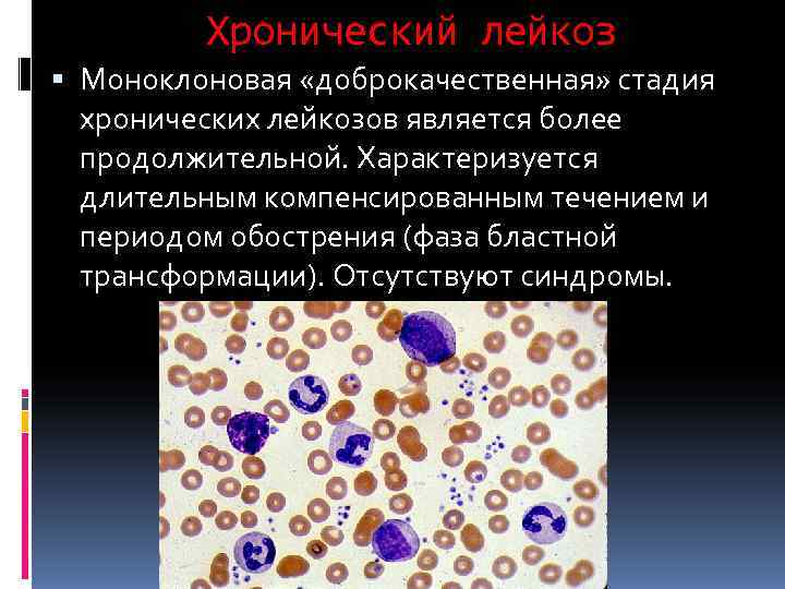    Хронический лейкоз  Моноклоновая «доброкачественная» стадия  хронических лейкозов является более
