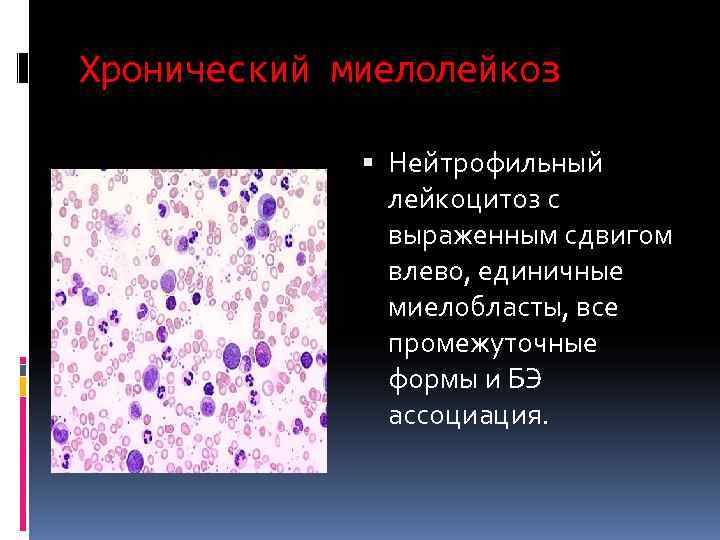Хронический миелолейкоз   Нейтрофильный    лейкоцитоз с    выраженным