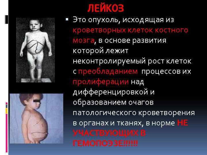  ЛЕЙКОЗ  Это опухоль, исходящая из  кроветворных клеток костного  мозга, в