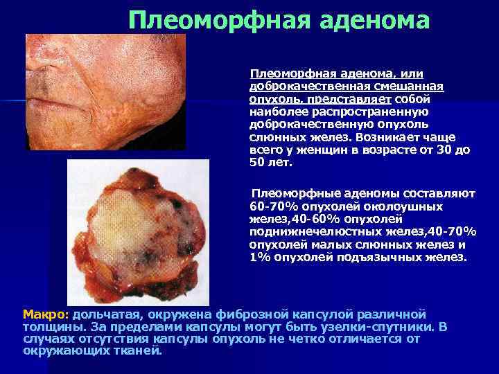    Плеоморфная аденома      Плеоморфная аденома, или 