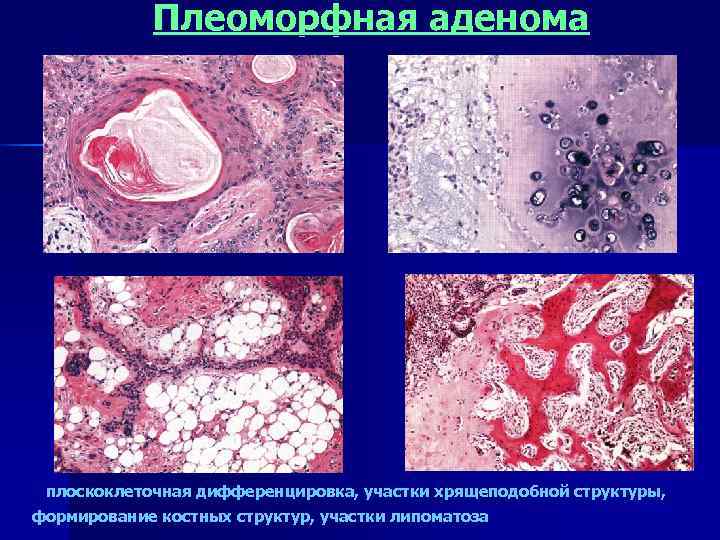    Плеоморфная аденома плоскоклеточная дифференцировка, участки хрящеподобной структуры, формирование костных структур, участки