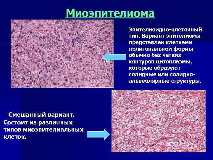     Миоэпителиома     Эпителиоидно-клеточный    