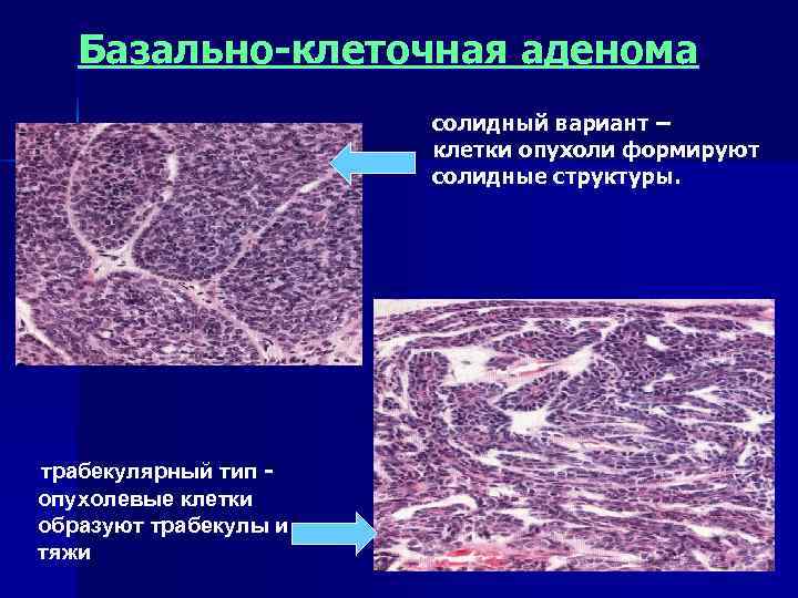 Доброкачественные и злокачественные опухоли слюнных желез презентация